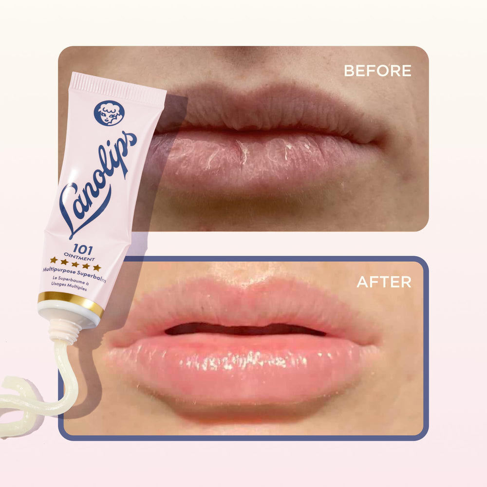 Lanolips 101 Ointment used for nipple-area care during nursing.