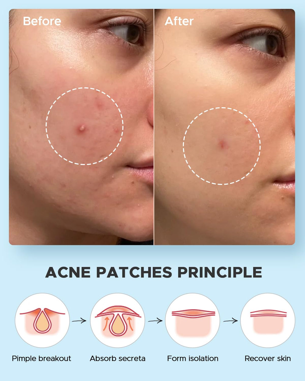 LitBear acne patches applied on a cheek demonstrating invisible daytime wear.