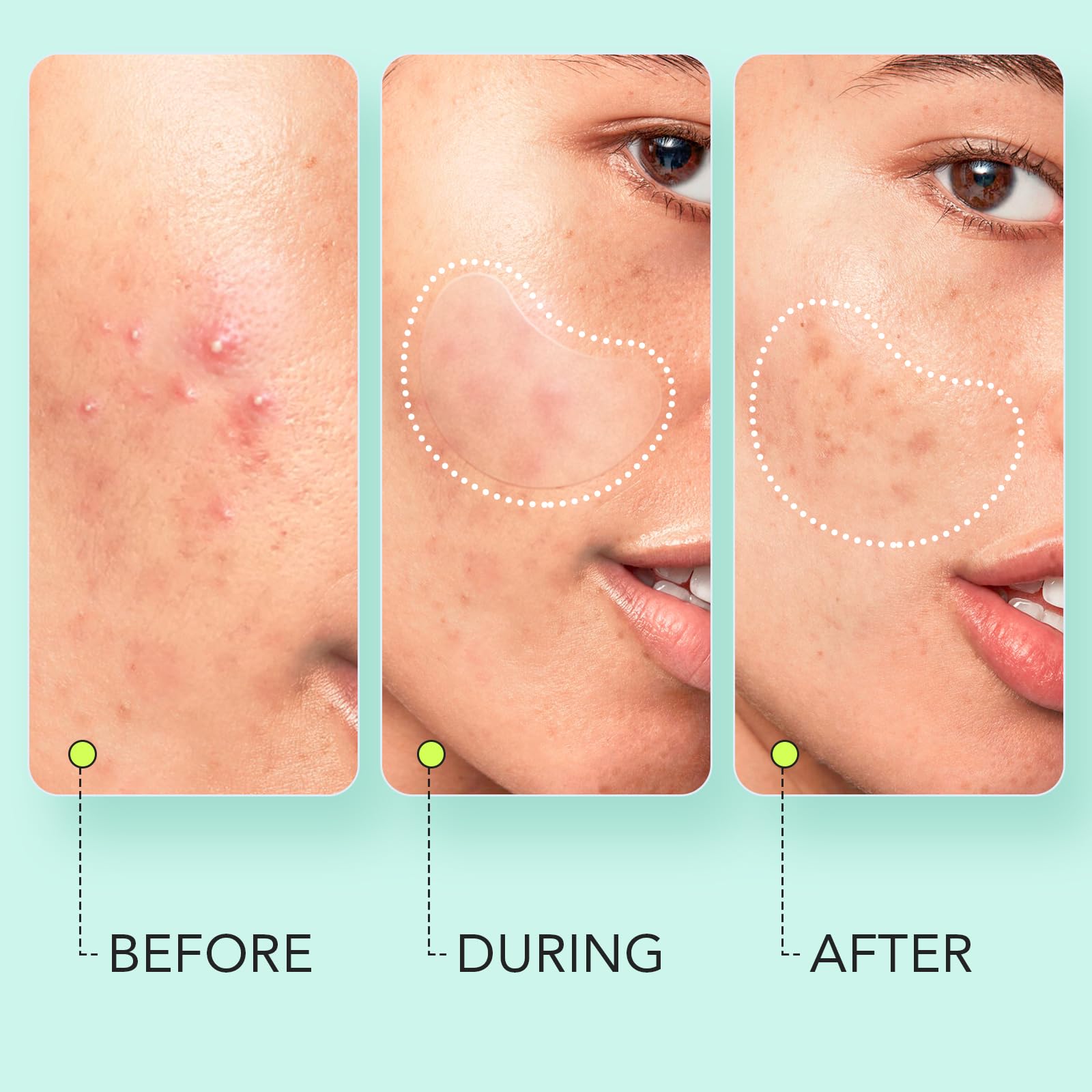 LitBear large pimple patches 26x38mm for bigger breakouts on face or body