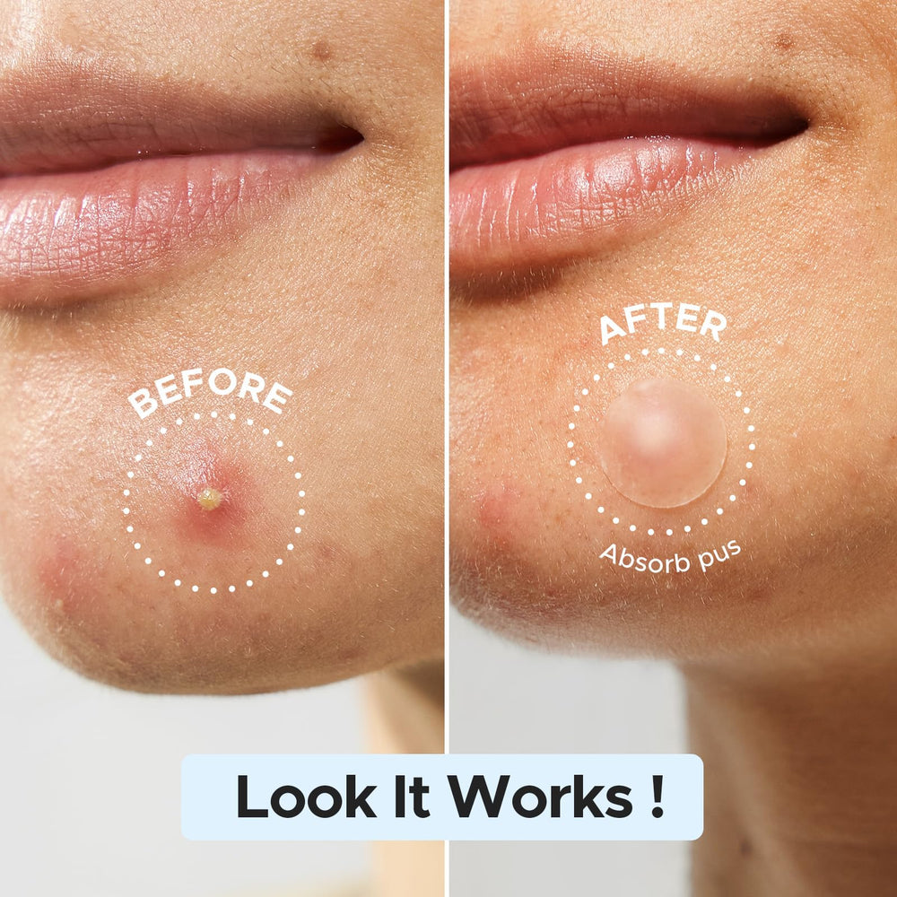 LitBear pimple patch 12mm for bigger blemishes with full coverage.