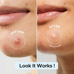 LitBear pimple patch 12mm for bigger blemishes with full coverage.