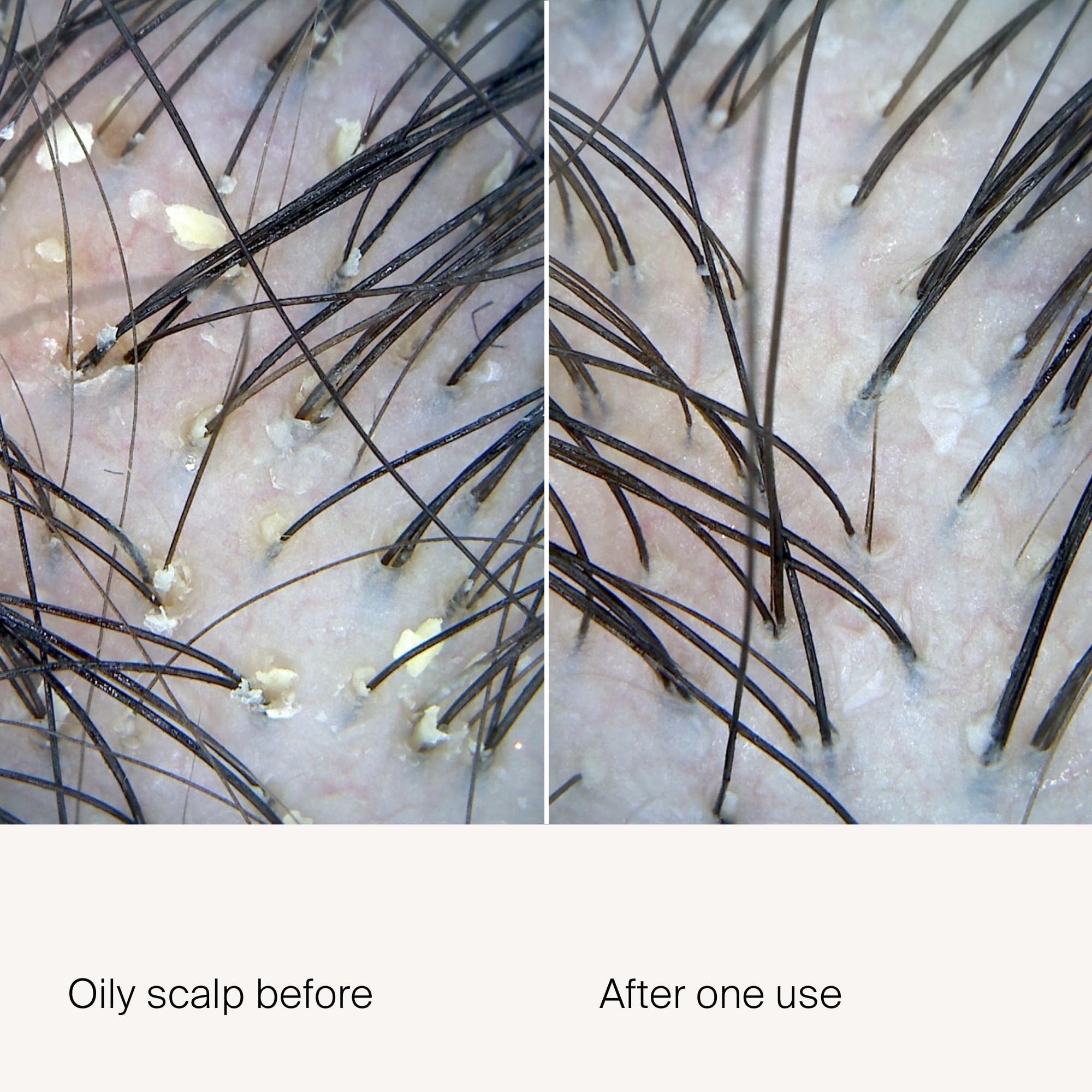 Living Proof Scalp Care Exfoliator direct-tip applicator enables targeted, mess-free scalp treatment.