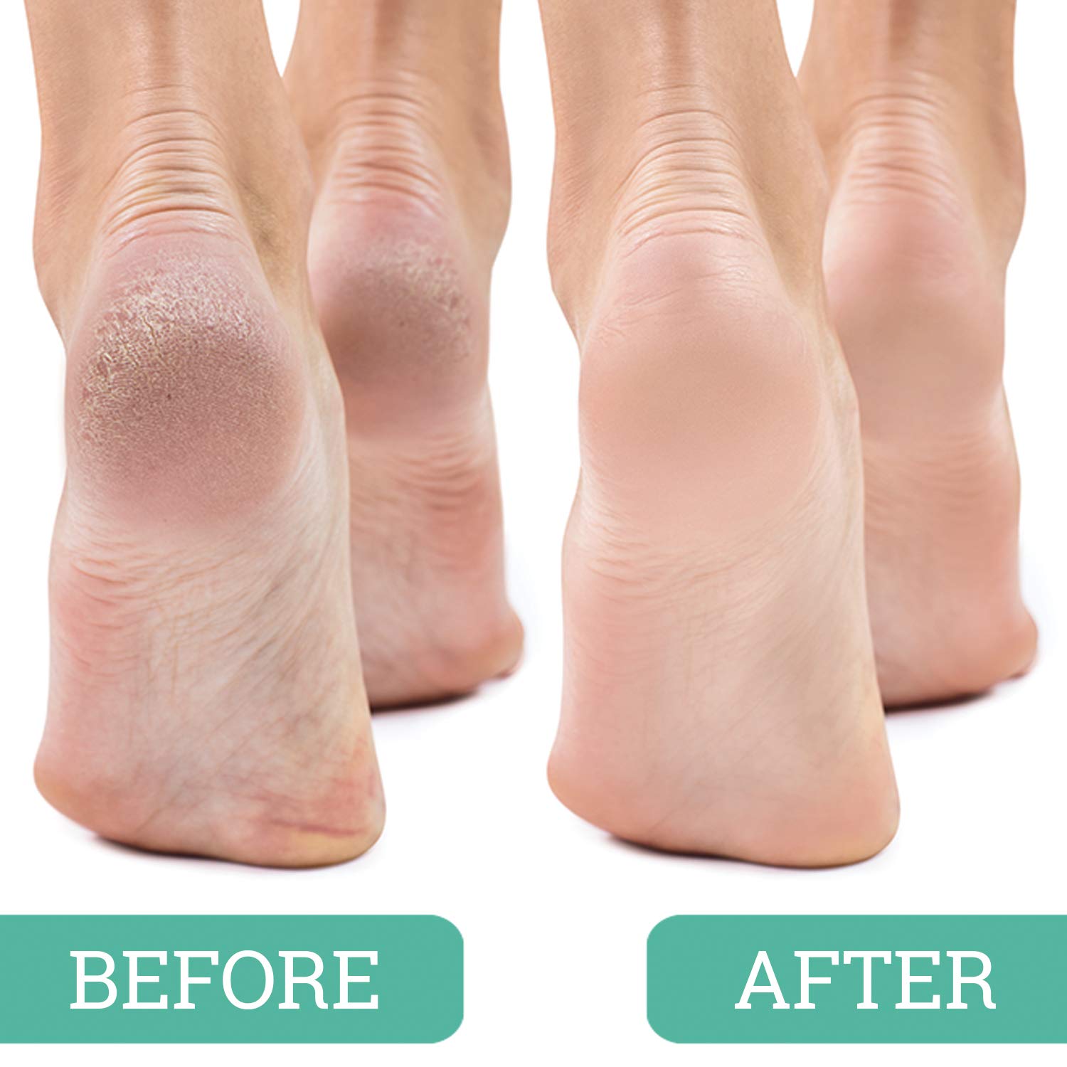 Maccibelle Callus Removal Tool Easy Grip enables safe, precise heel exfoliation.