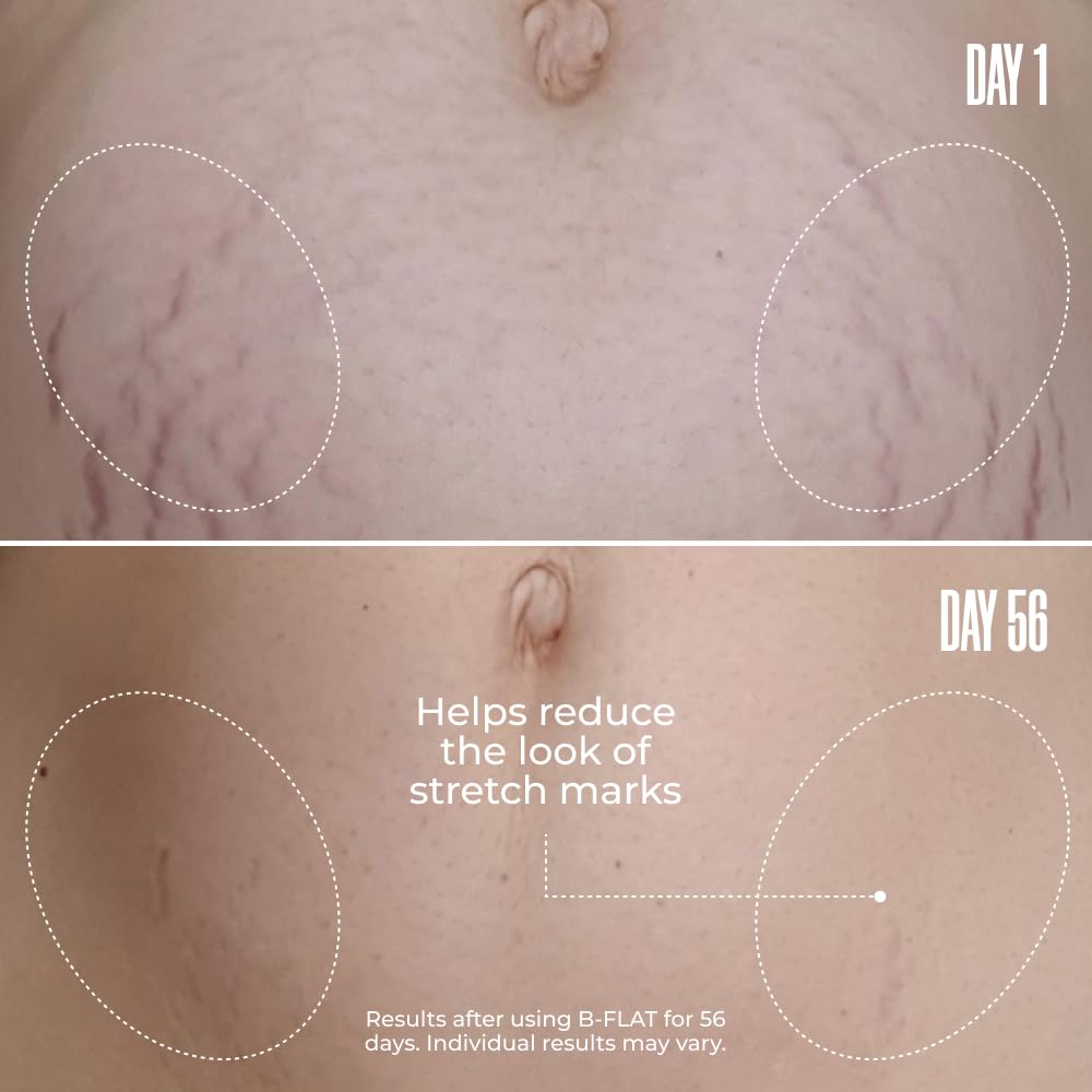 MAËLYS B-FLAT application demonstrates circular massage for smoother belly skin.