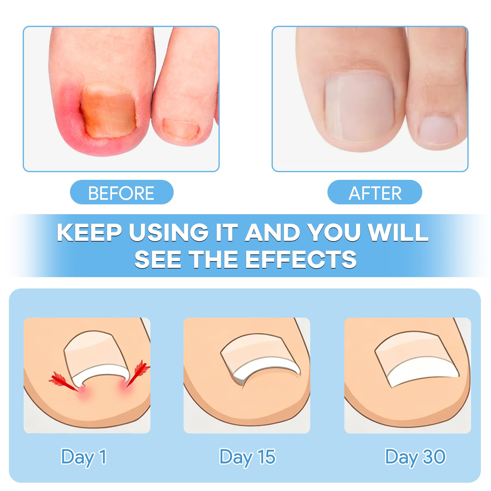 Maliyscent ingrown-toenail-kit-strips ready for comfortable daily wear and reduced irritation
