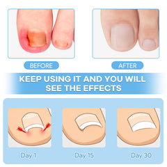 Maliyscent ingrown-toenail-kit-strips ready for comfortable daily wear and reduced irritation