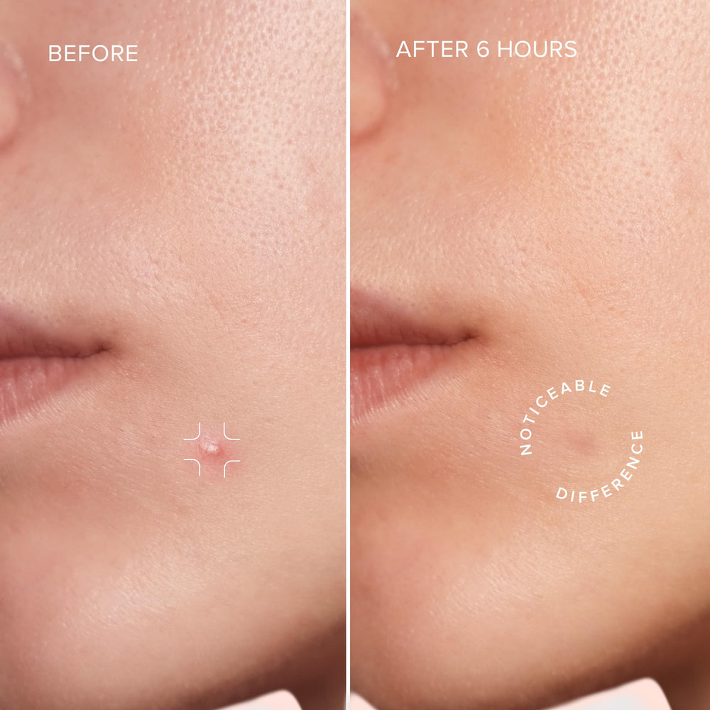 MAREE Star Pimple Patches on skin demonstrate salicylic acid for blemish-focused care.