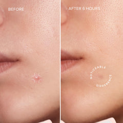 MAREE Star Pimple Patches on skin demonstrate salicylic acid for blemish-focused care.