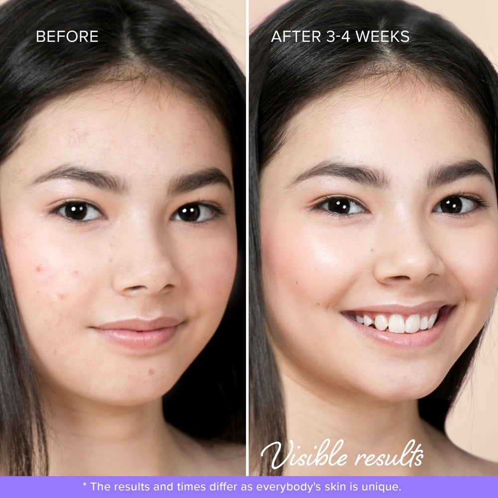 MAREE Star Pimple Patches are teen-friendly and ideal for school mornings.