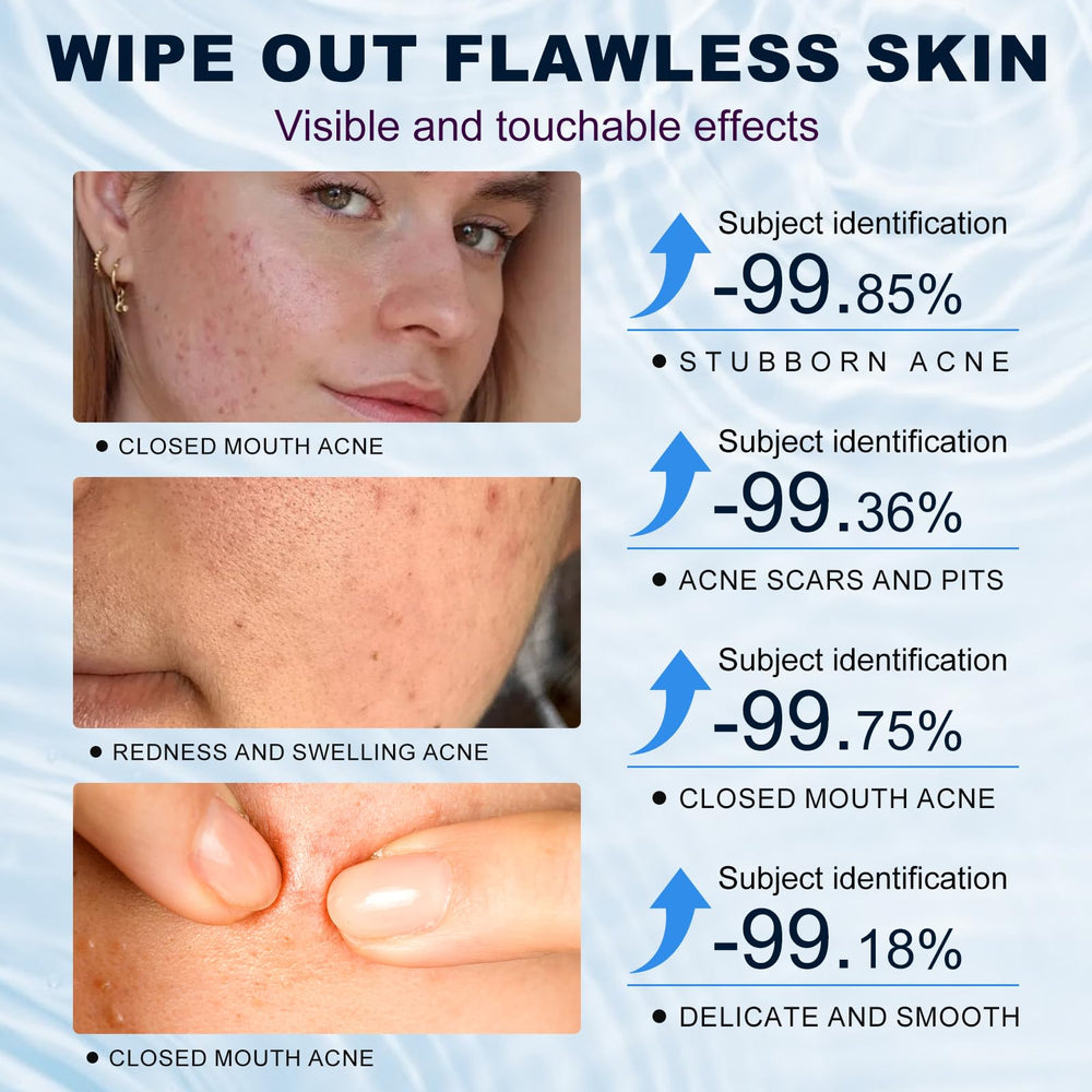 Marianp Azelaic Acid 10% Cream gentle-formulation suits all skin types.