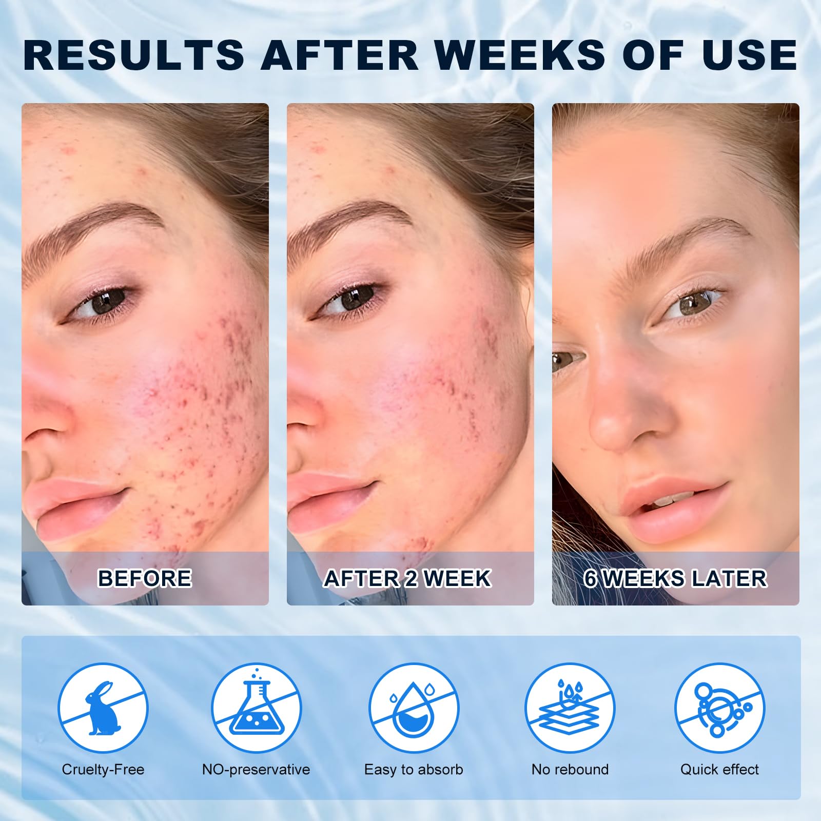 Marianp Azelaic Acid 10% Cream pigmentation-before-after hints at more even tone.