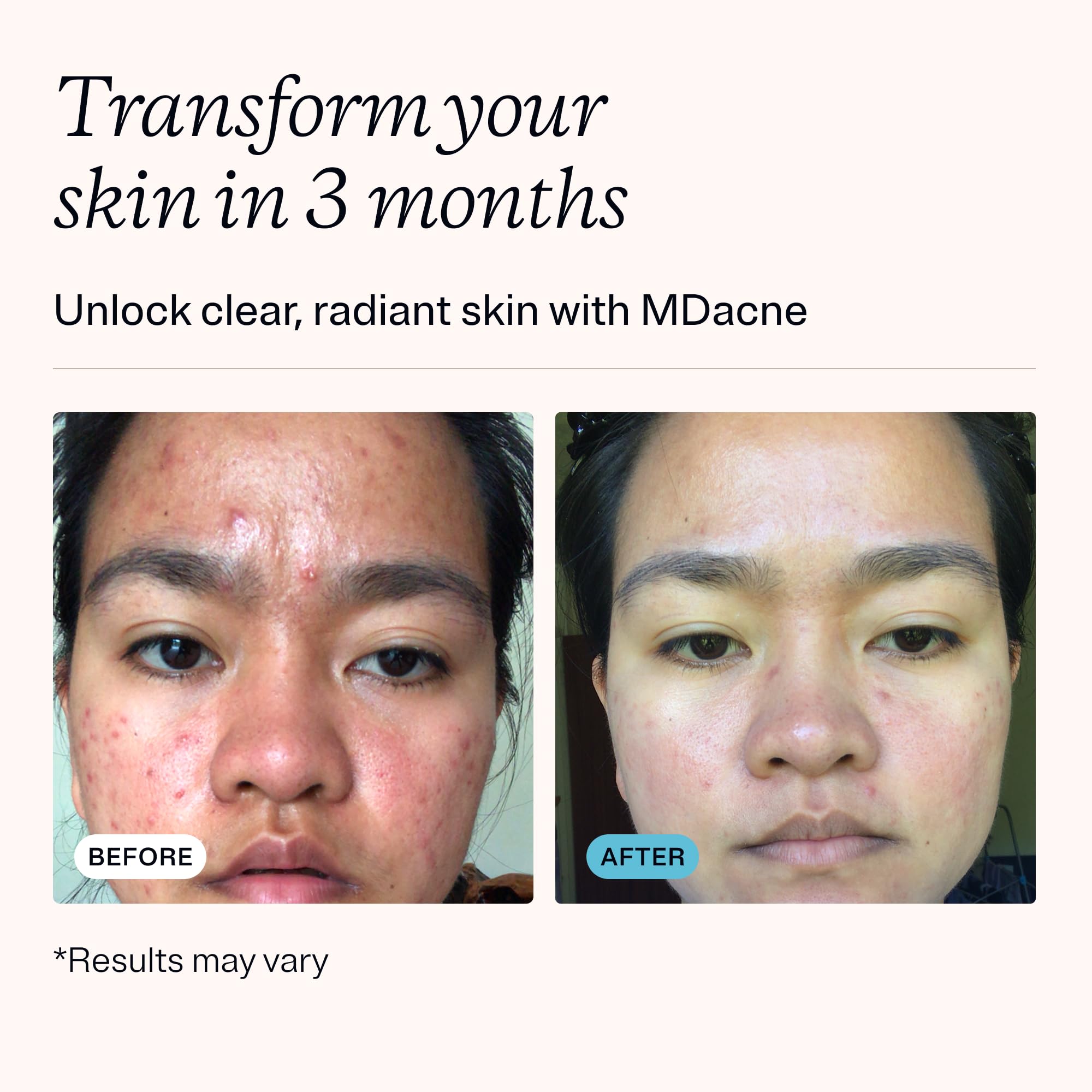 MDacne niacinamide moisturizer hydrates while supporting barrier repair for sensitive and acne-prone skin.