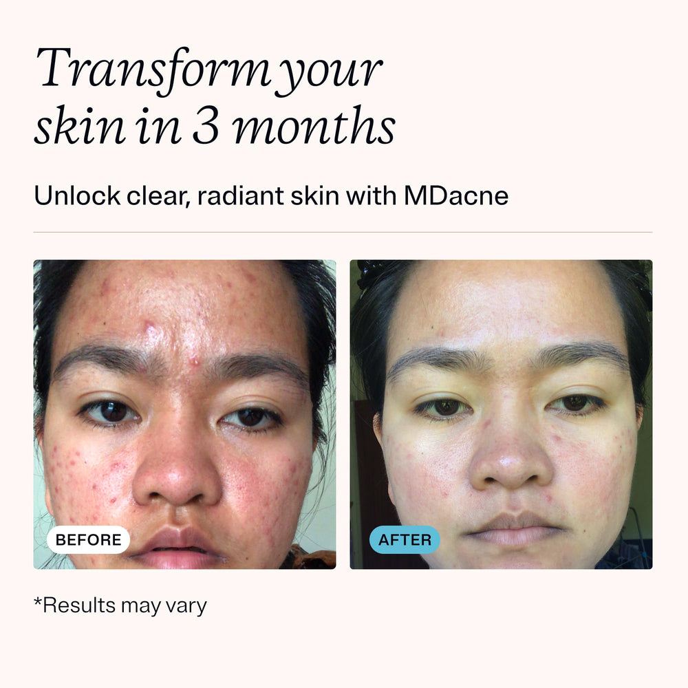 MDacne niacinamide moisturizer hydrates while supporting barrier repair for sensitive and acne-prone skin.