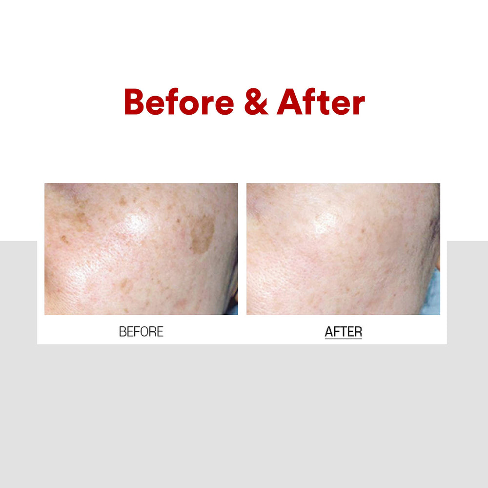 Medi-Peel Melanon X Cream spot treatment use on freckles for targeted care.