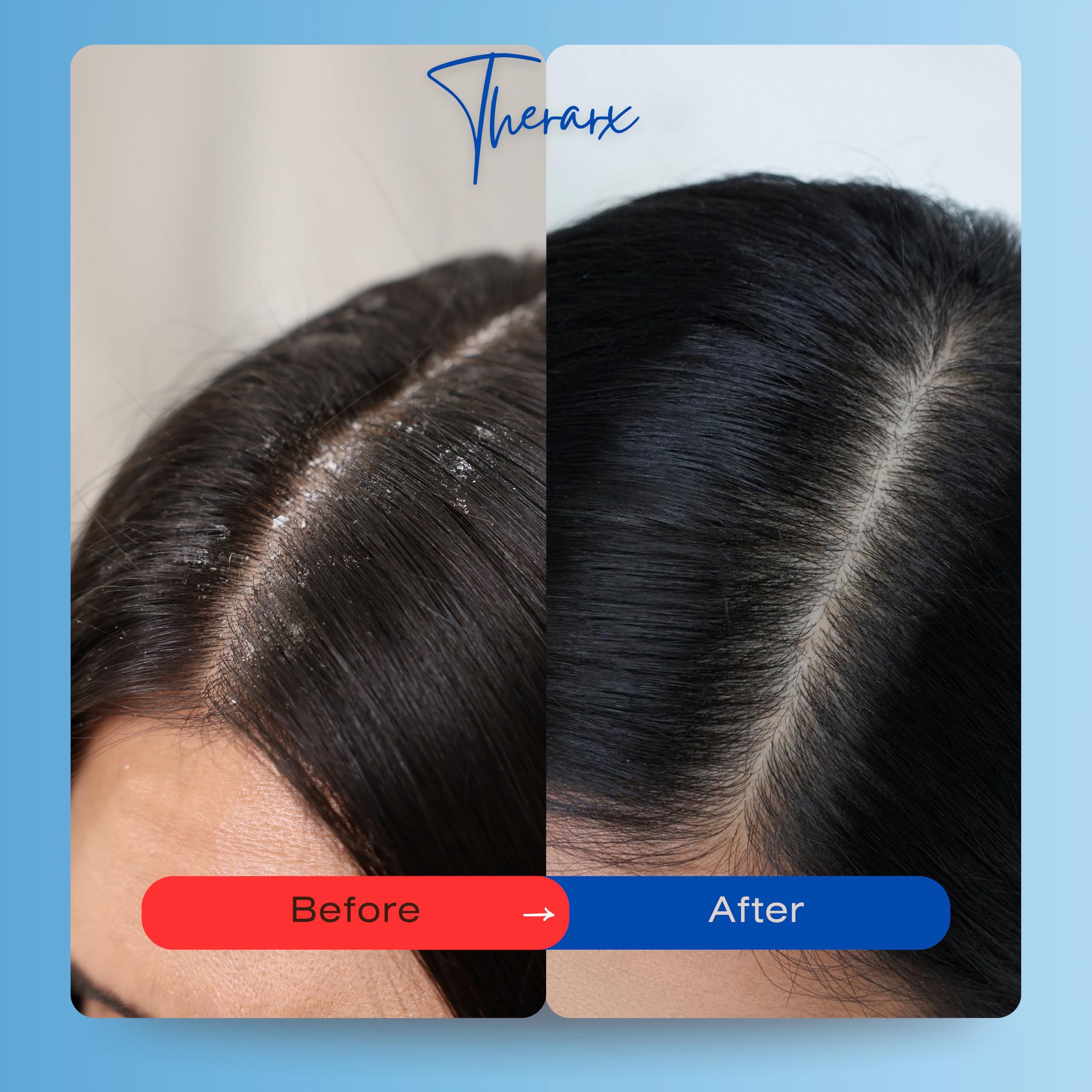 Mediceuticals TheraRx wash lather closeup shows rich texture for thorough scalp cleansing.