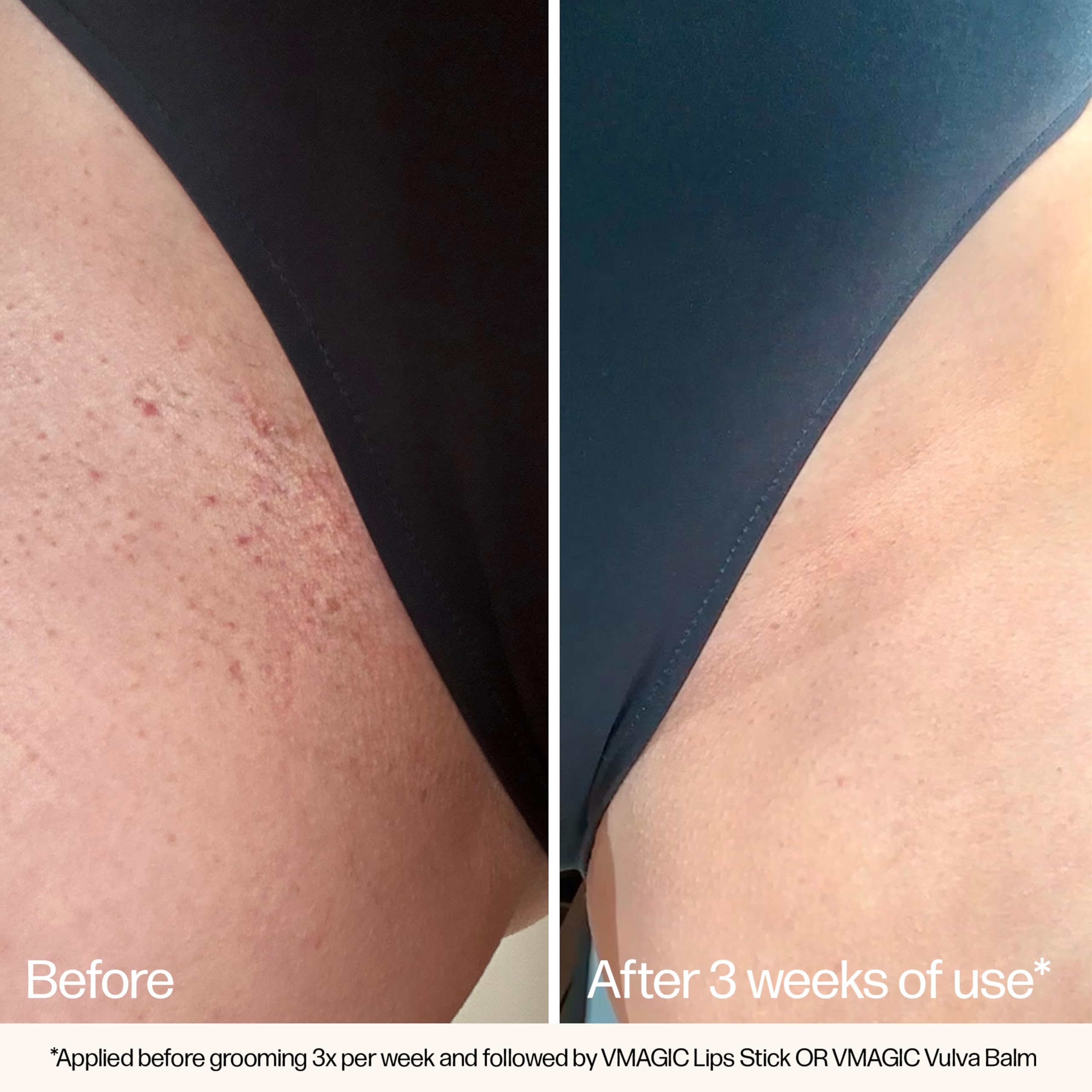 VMAGIC hands applying in bikini area highlight prep for waxing or shaving.