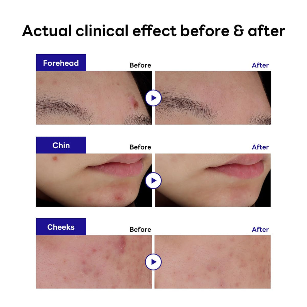 Mediheal Derma Clear patch on skin demonstrates soothing madecassoside and niacinamide for irritation.