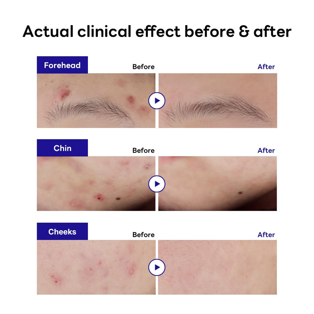 Mediheal Derma Clear Tea Tree Patch on skin appears invisible with a matte finish.