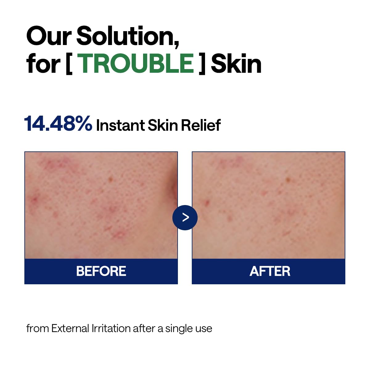 Mediheal Teatree Calming Serum application on face for quick calming ritual