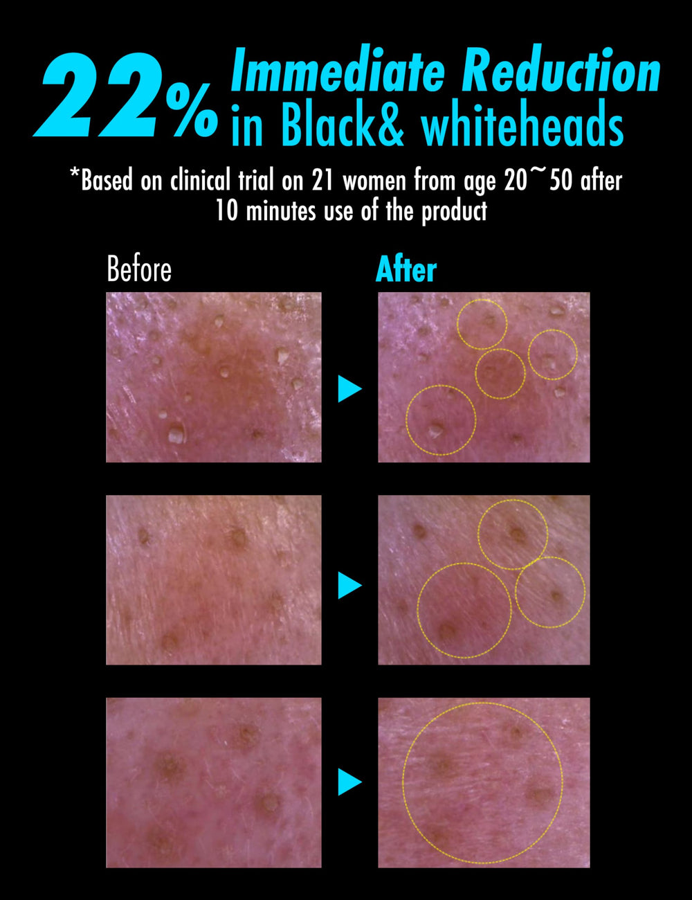 Meditime Pore Blackhead One Shot being applied for even coverage.