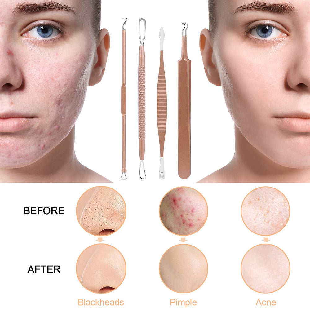 MENOLY rose-gold acne tool kit suitable for daily skincare routines.