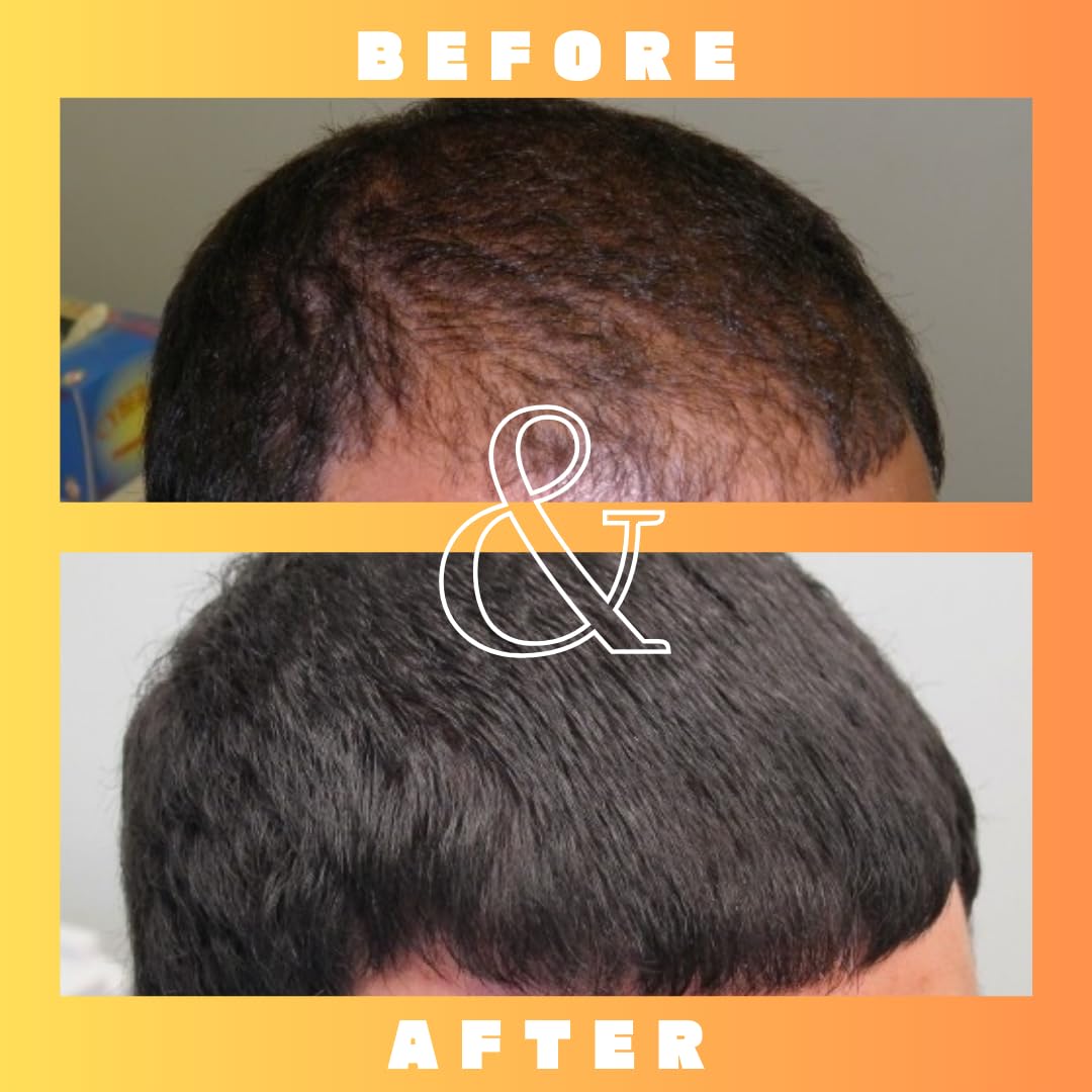 Mettle Mane RU58841 packaging box display conveys premium anti-hair-loss solution.