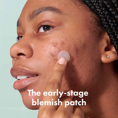 Mighty Patch 395 micropoints close-up showing precision blemish targeting.