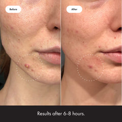 Mighty Patch Invisible+ patch on face under makeup for daytime stealth.