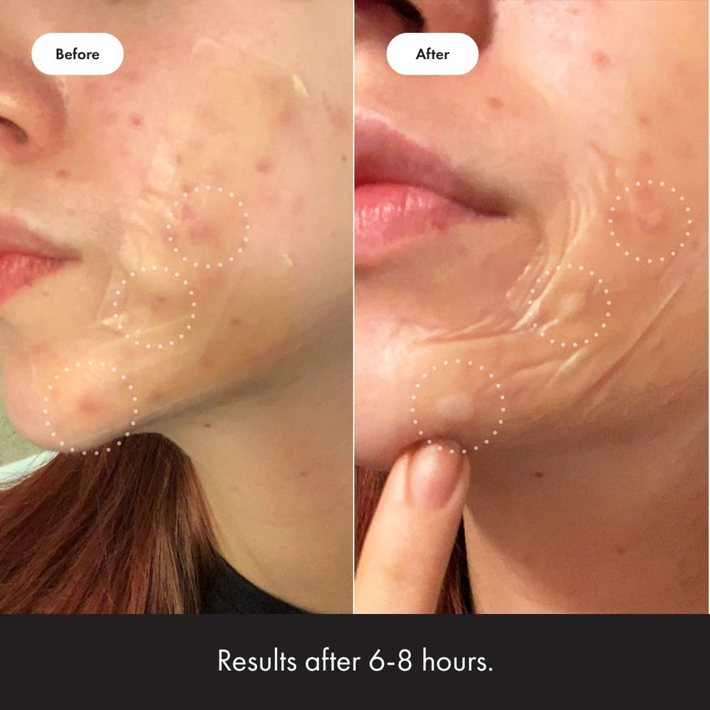 Mighty Patch Surface jawline coverage demonstrates seamless fit and staying power