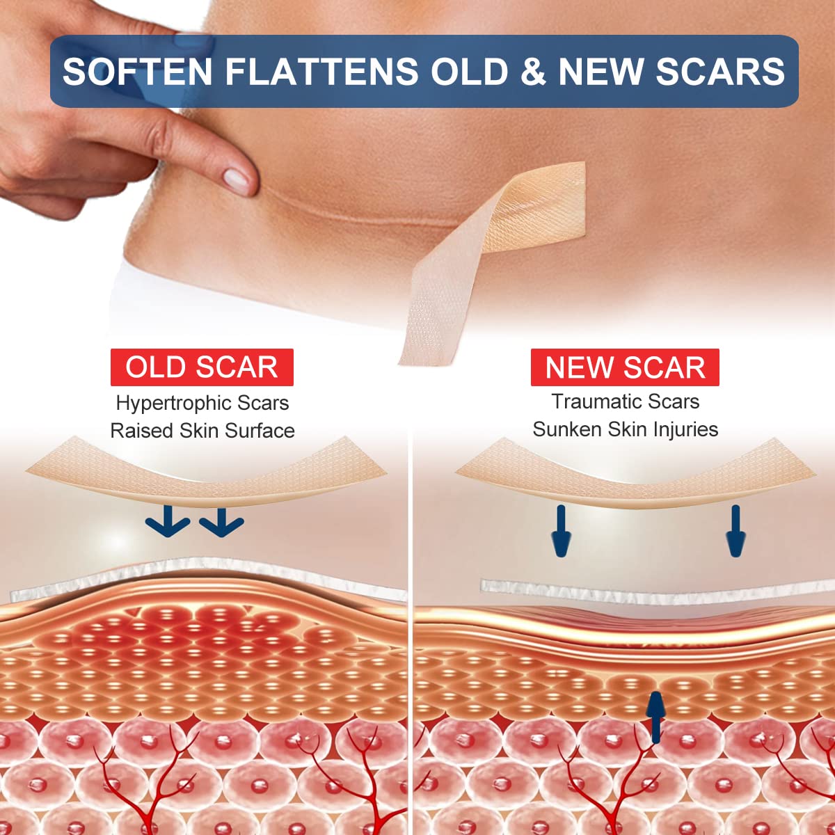 MINGYITUO scar tape closeup shows soft medical-grade silicone for comfortable wear.