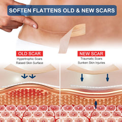 MINGYITUO scar tape closeup shows soft medical-grade silicone for comfortable wear.