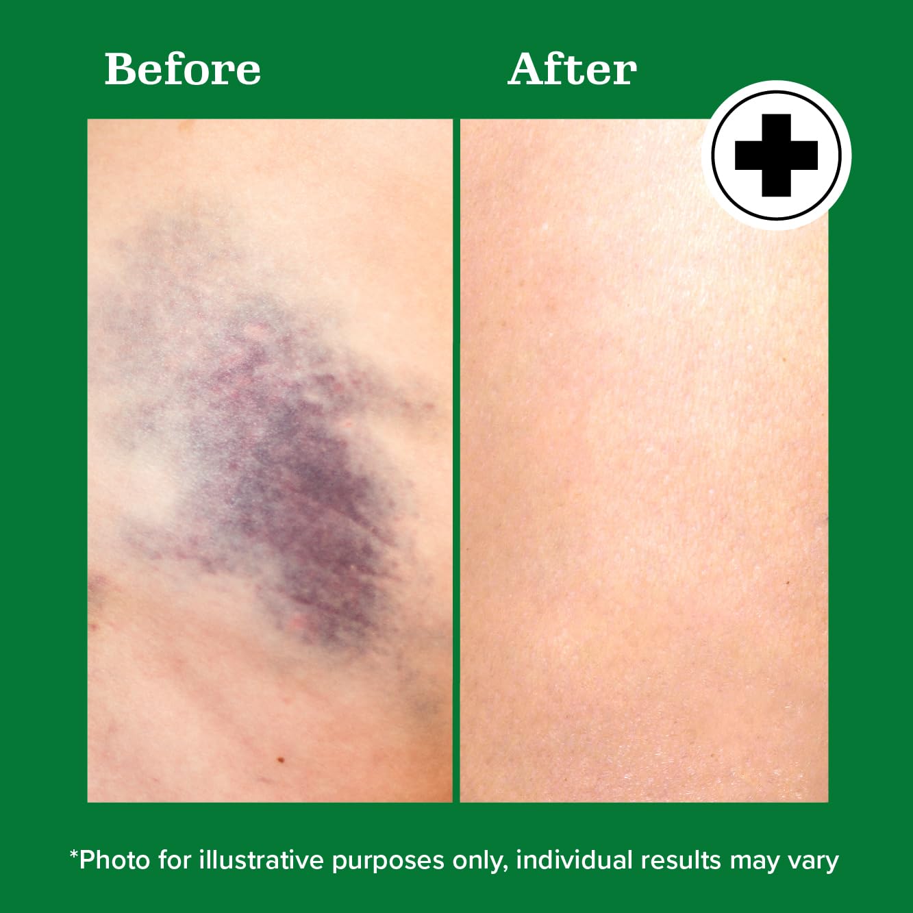 Miracle Plus Arnica Gel used after surgery to help bruise management.