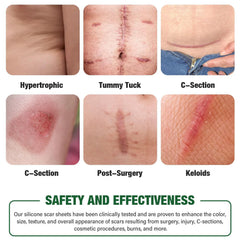 Mitreal silicone sheets for scar appearance showing softened texture and hydration