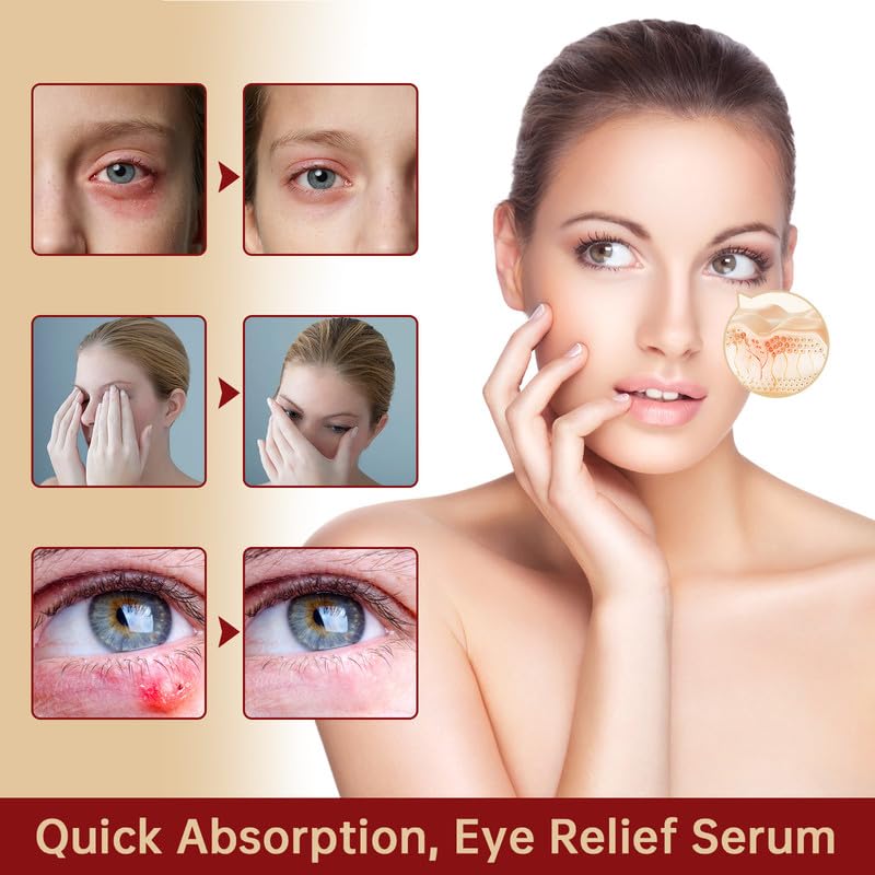 MIZEEYE Styes Eye Relief Serum lid closeup promoting calm, refreshed eyelids