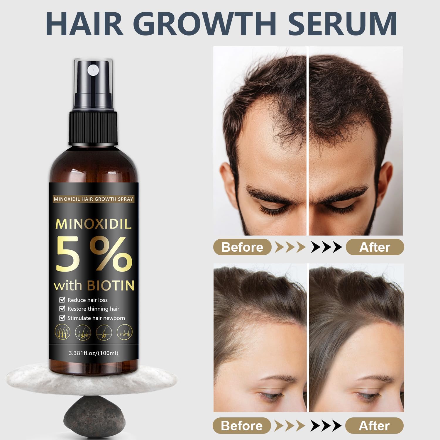 MOC LINK Minoxidil beard growth application near jawline for fuller facial hair