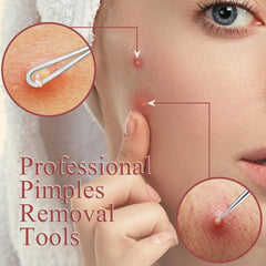 MORGLES Non-slip pimple extractor tools enable controlled blemish removal