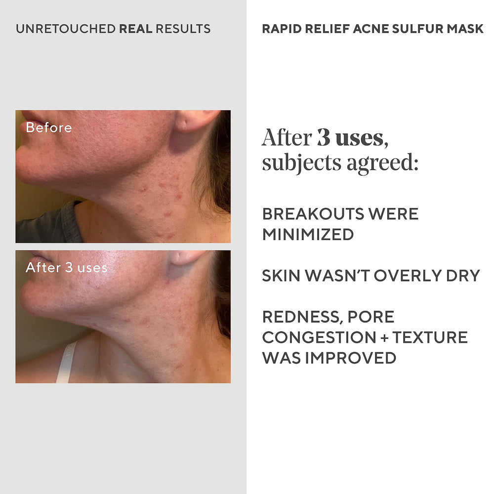 Murad Rapid Relief sulfur exfoliant shown on skin