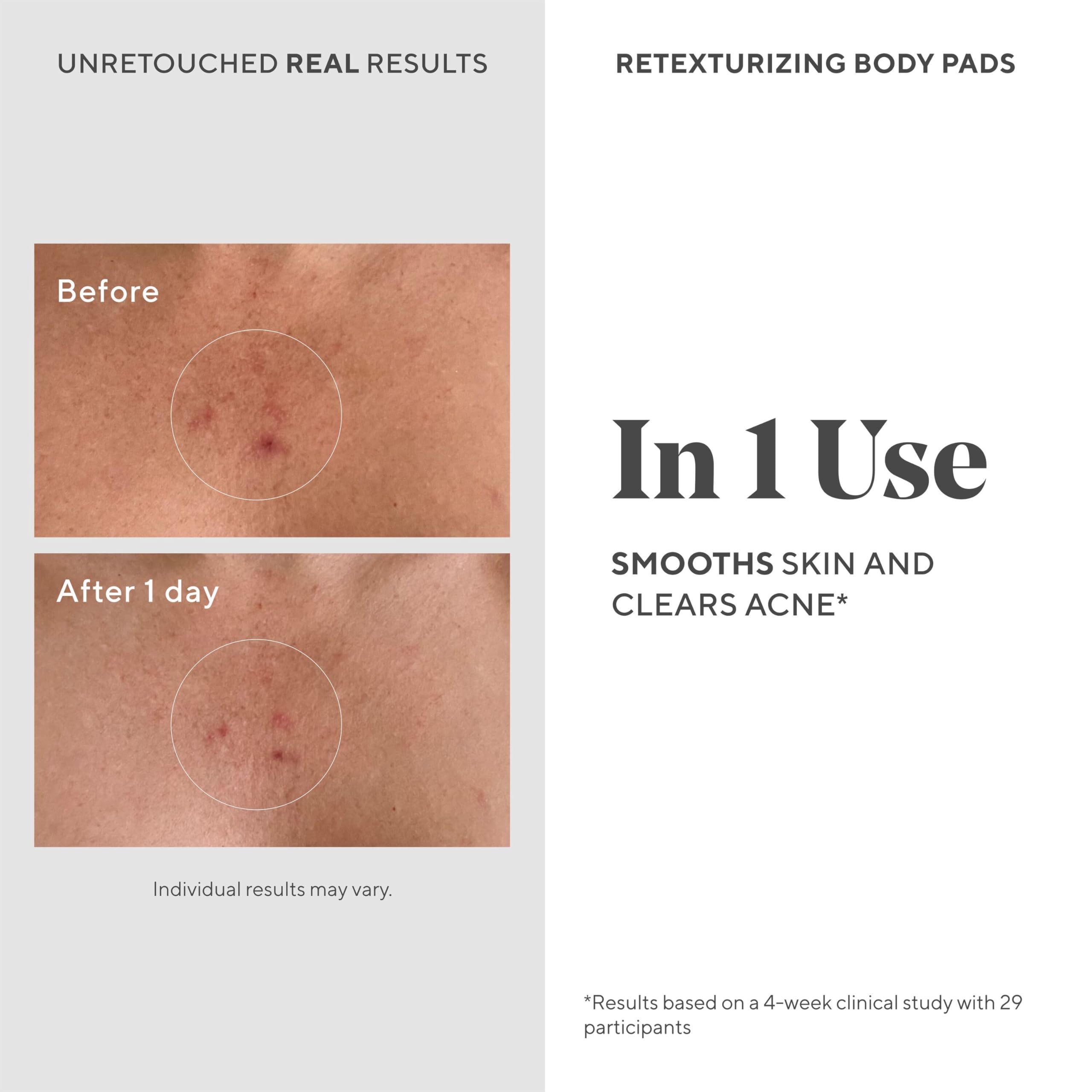 Murad Retexturizing Body Pad applied to forearm for acne-prone skin
