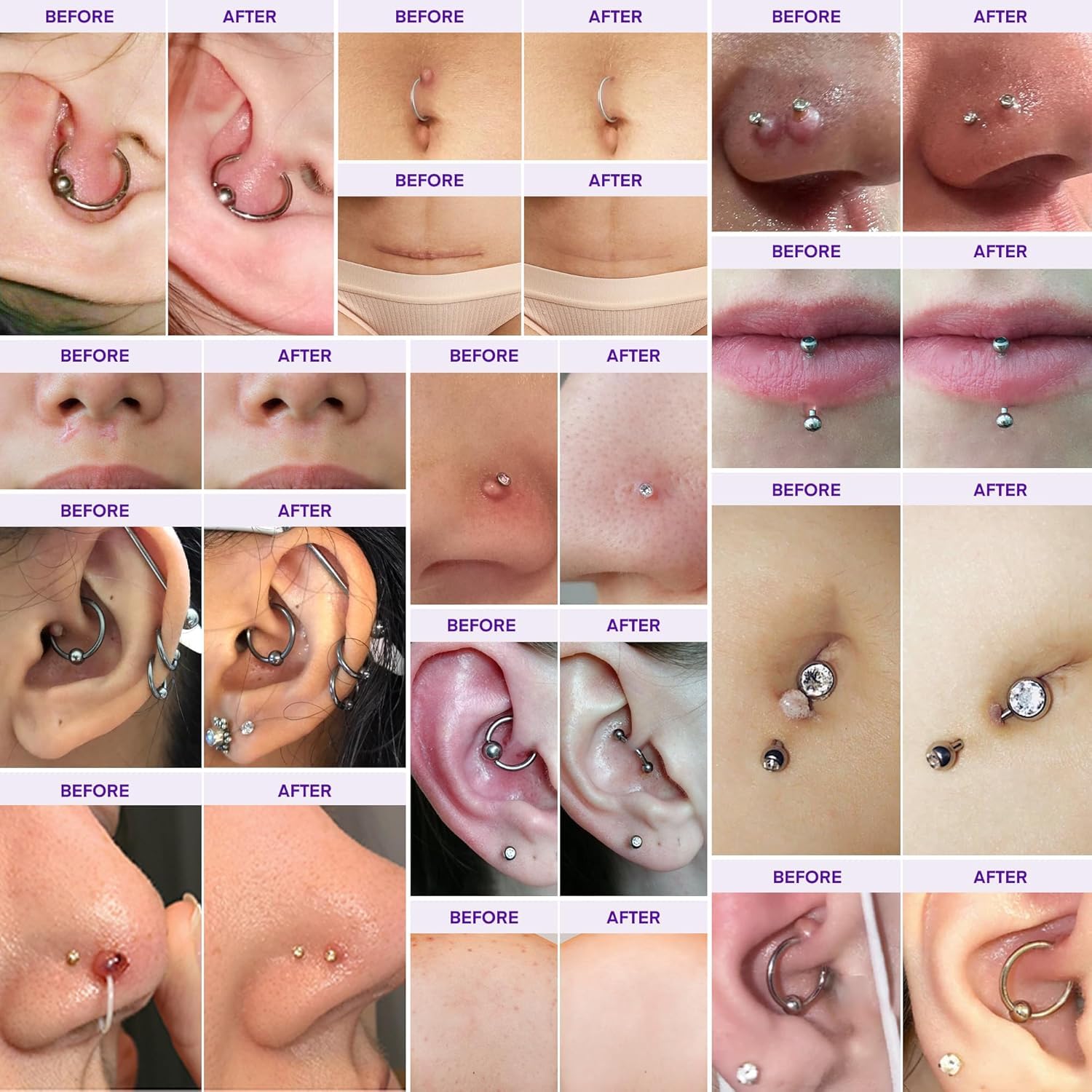 MURASAKI BEAUTY keloid bump gel applying on skin for scar repair and soothing relief.