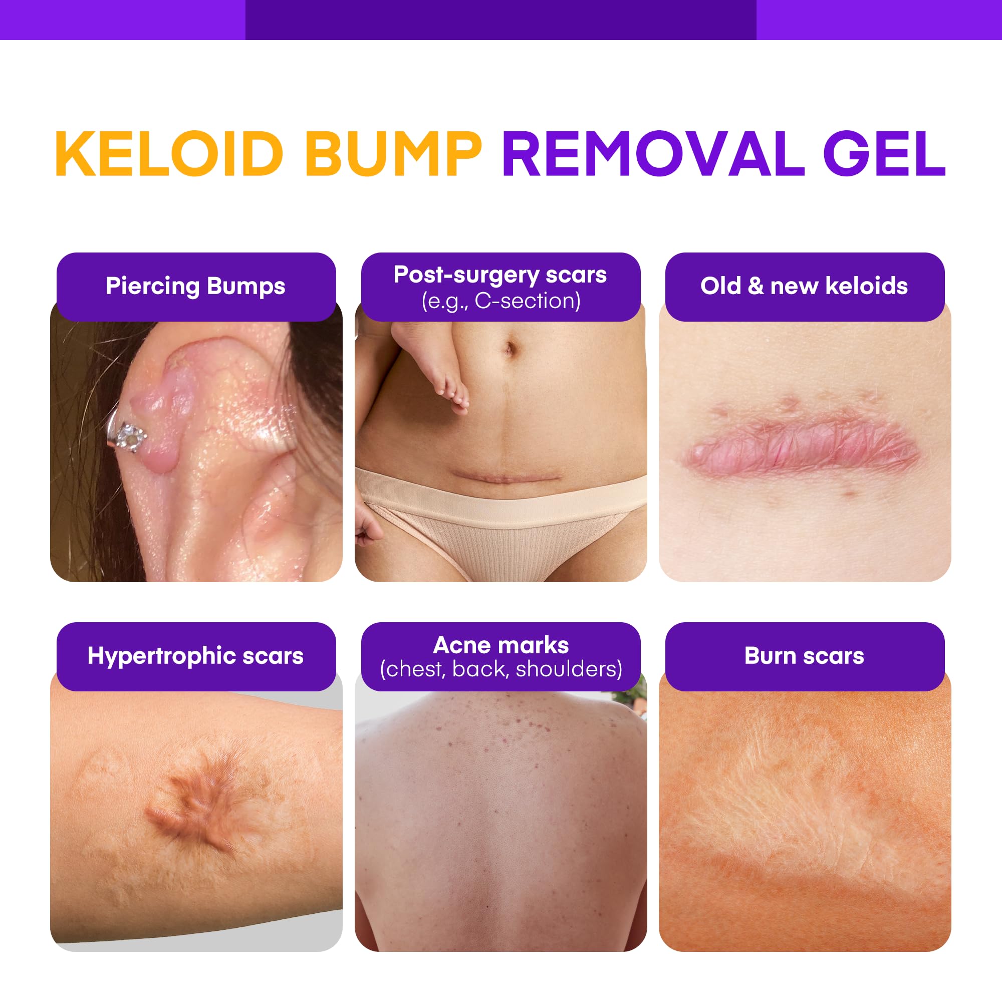 MURASAKI BEAUTY keloid bump gel close-up texture, light and non-greasy for sensitive skin.