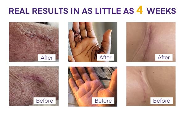 MURASAKI BEAUTY silicone scar gel for easy daily use