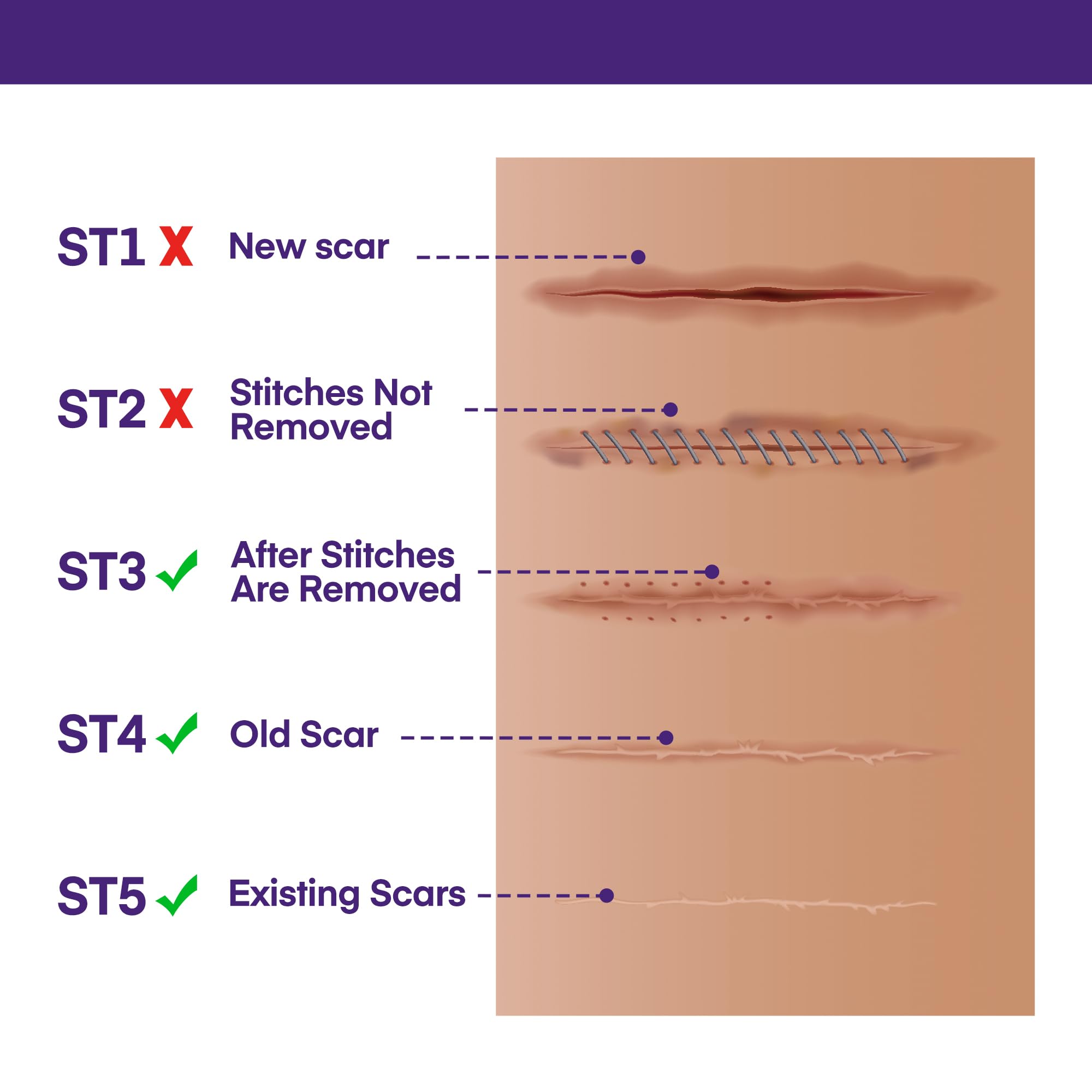 MURASAKI BEAUTY silicone scar gel demonstrated for surgical scars