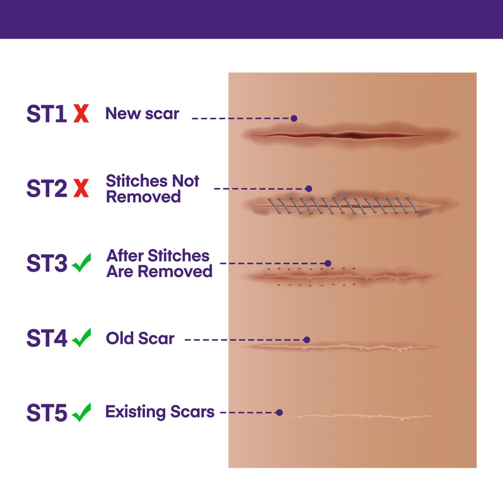 MURASAKI BEAUTY silicone scar gel demonstrated for surgical scars