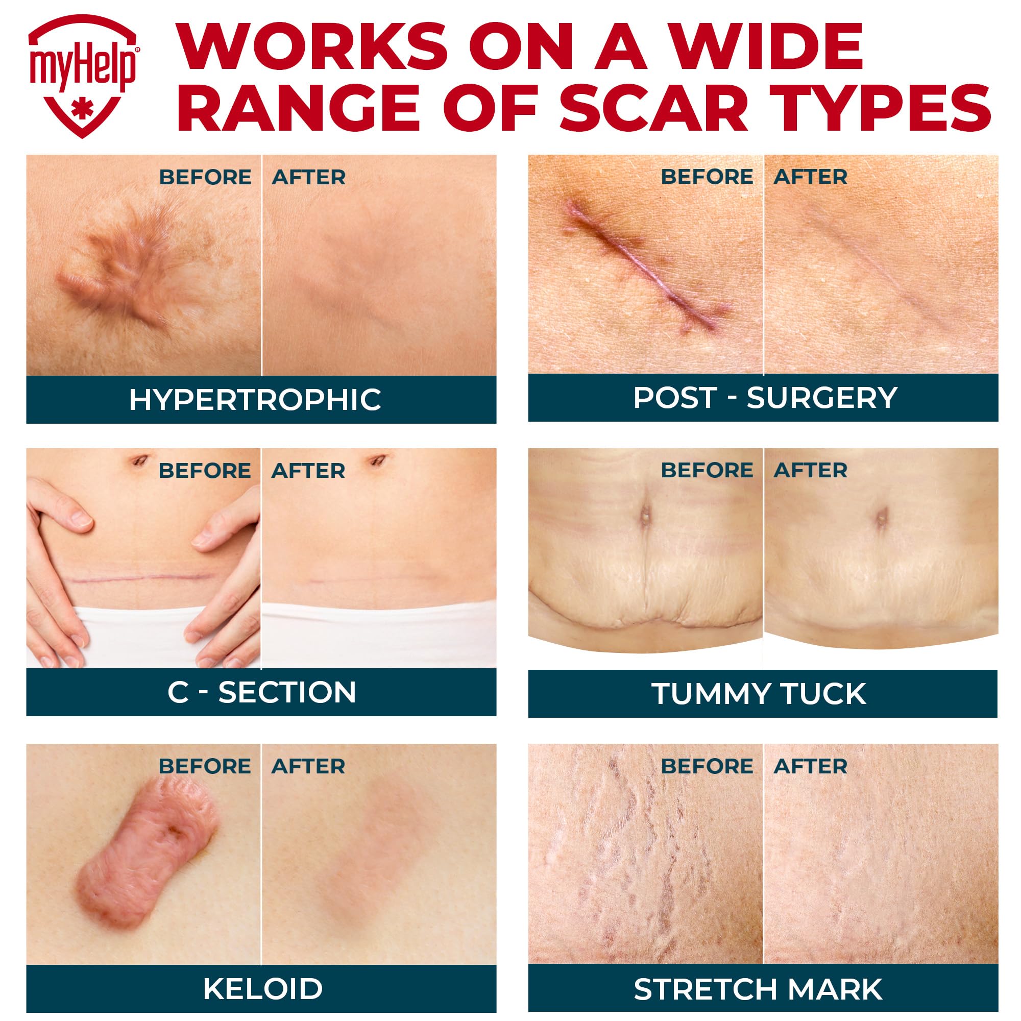 MYHELP silicone scar tape on surgical scar with flat, smooth contours.