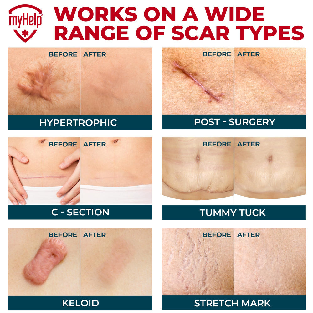 MYHELP silicone scar tape on surgical scar with flat, smooth contours.