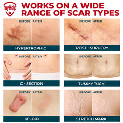 MYHELP silicone scar tape on surgical scar with flat, smooth contours.