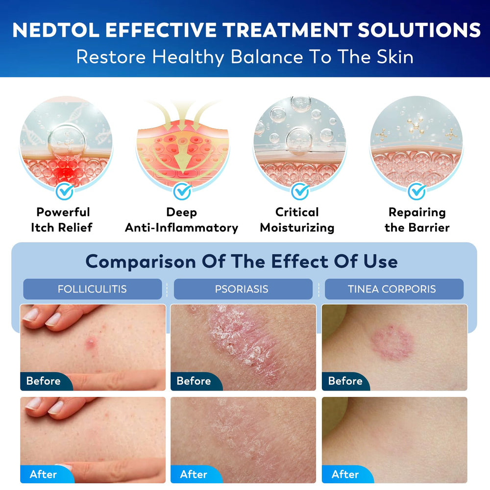 Nedtol Folliculitis Cream application on skin demonstrates quick soothing use.
