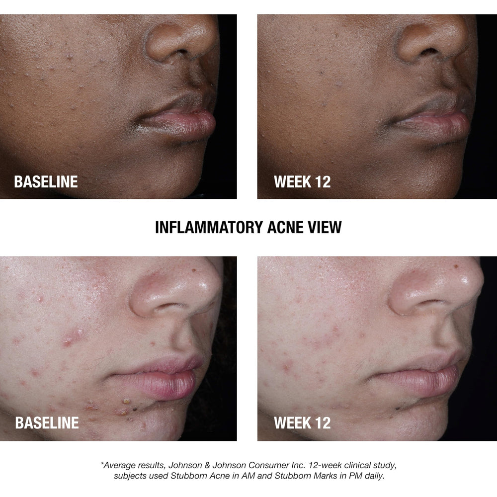 Application scene of Neutrogena AM Treatment being applied to skin for quick action.