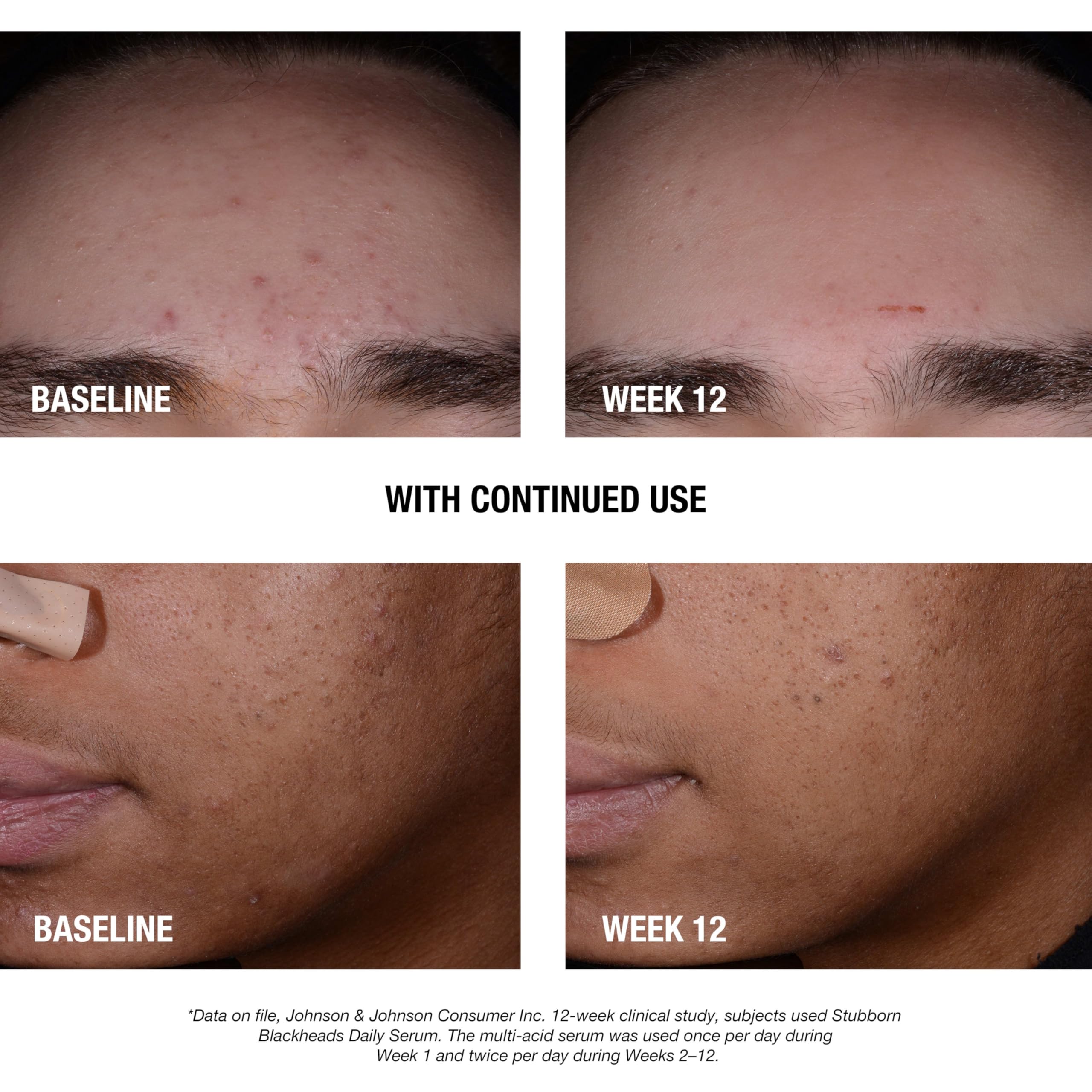 Texture close-up of Neutrogena Stubborn Blackheads serum showing lightweight, quick-absorbing formula.