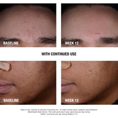 Texture close-up of Neutrogena Stubborn Blackheads serum showing lightweight, quick-absorbing formula.